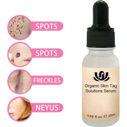 1/3Pcs Mole And Skin Tag Remover Liquid Genital Wart Treatment Papillomas Removal Of Warts Skin Tags Removing Against Moles