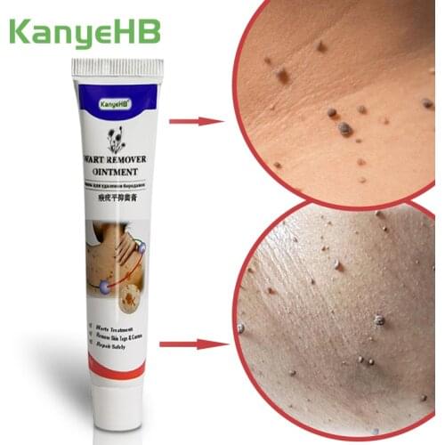 Warts Remover Antibacterial Ointment Wart Treatment Herbal Extract Corn Calluses Removal Plaster Warts Ointment Skin Care 1pcs