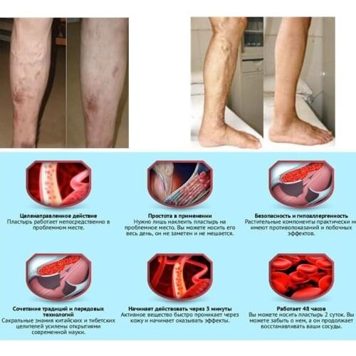 24 Pcs Spider Veins Varicose Treatment Plaster Varicose Veins Cure Patch Vasculitis Natural Solution Herbal Patches