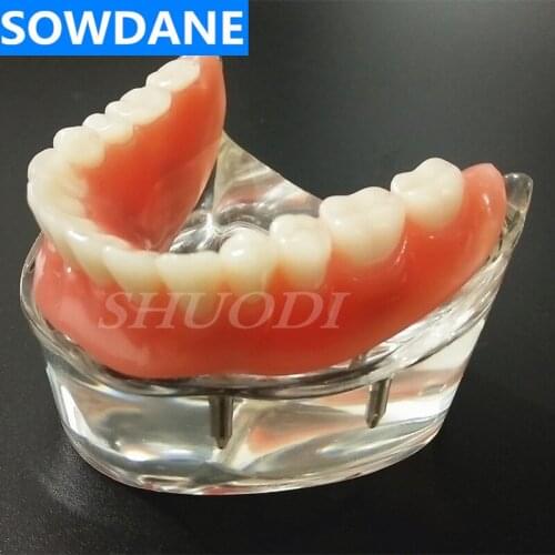 Dental Overdenture Interior Mandibular Lower with 4 Implant Restoration Teeth Study Teach Teaching Model