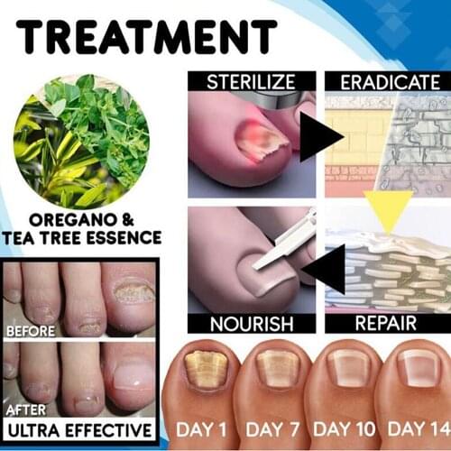 Toe Fungal Nail Pen 3ml Anti Fungal Repair Gel Nail Pedicure Fingernail Care