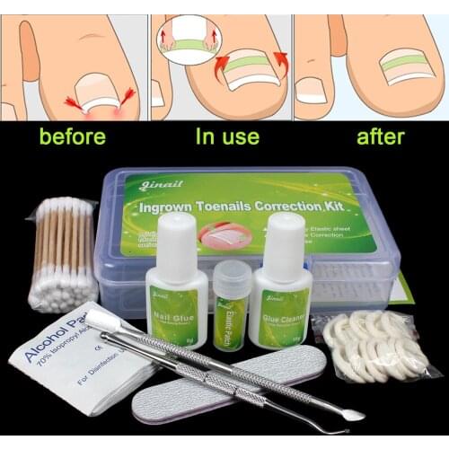 Healthy nails 12pcs Standard kit FOR Mildly Ingrown Toenail Straightening Clip Curved BS Brace Thick Paronychia Correction Tool