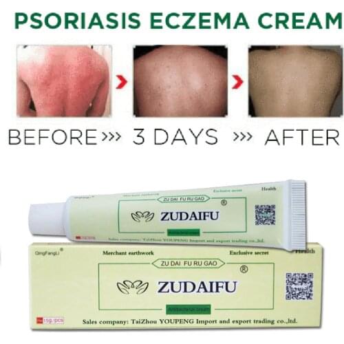 1 piece Hot selling zudaifu Body Psoriasis Cream Psoriasis Ointment Skin Care Body Cream with Retail Box