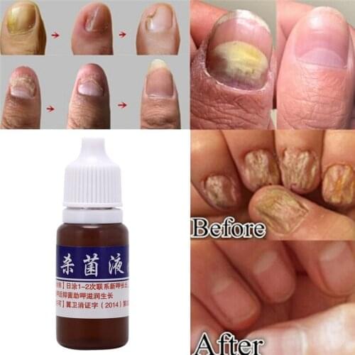 10ml Health Skin Care Nail Repair Treatment Liquid Cleanser Onychomycosis Remove