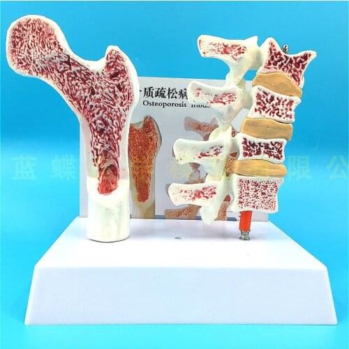Femur osteoporosis Anatomical model Osteolysis section of leg Spine section specimen Model of diseased lumbar spine