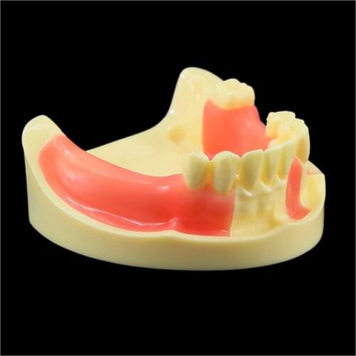 Dental Practice Implant Training Model Lower Jaw Typodont 2004