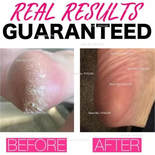 1Pairs Exfoliating Foot Peeling Mask Exfoliating Feet Peel Mask Remove Dead Skin Calluses Sheds Skin Baby Foot