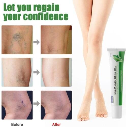 Sumifun New Varicose Veins Treatment Cream 100% Original Vasculitis Phlebitis Spider Pain Relief Ointment Medical Plaster