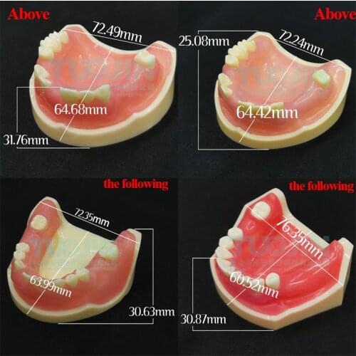Dental Implant Typodont Restoration Disease Analysis Demo Study Teeth Model