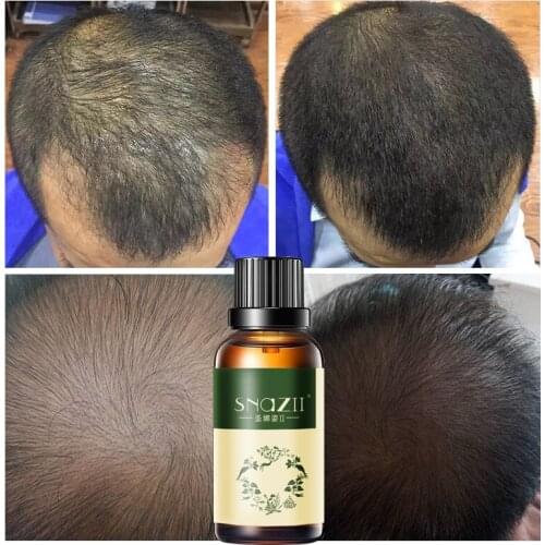 Licuadora de belleza Hair Loss Remedies