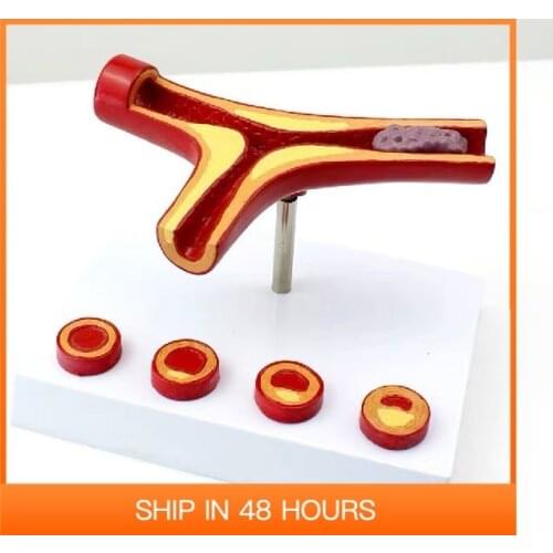Arteriosclerosis Model with Thrombus for Sale Human Artery Anatomical Blood Vessel Anatomy Medical Gift Teaching Tool