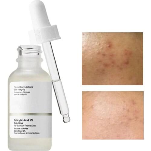 Salicylic Acid 2% Solution Essence 30mL Acne Spot Removing Shrink Pores Oil-Control Brighten Face Skin Makeup