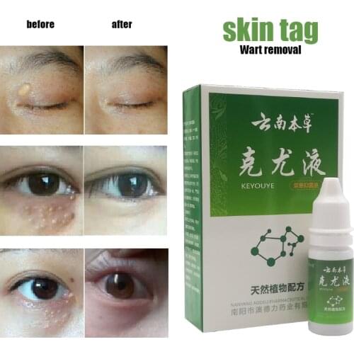 Skin Tag Remover Against Mole & Genital Wart fast RemovWithin Al Anti Foot Corn Removal Warts Papillomas Rapidly Removes Moles