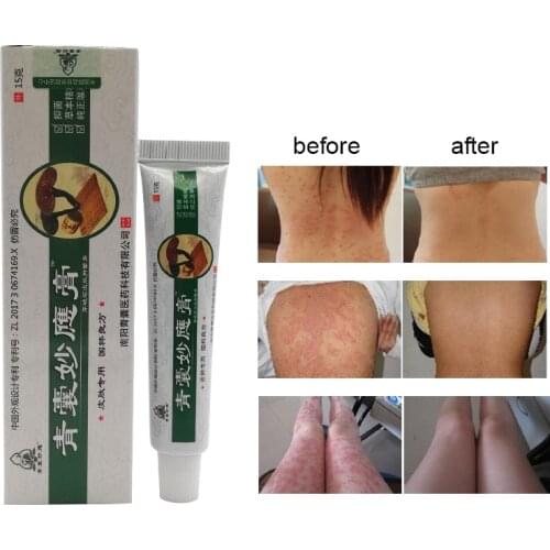 Ointment from Psoriasis Dermatitis Eczema Remove Skin Itching Antibacterial Mosquito Bites Natural Chinese Medicine Herbal Cream