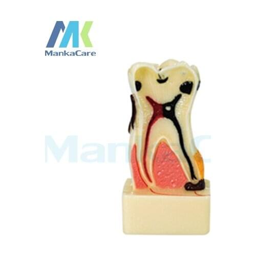 Manka Care - 4Times periodontal disease/Made of imported resin Oral Model Teeth Tooth Model