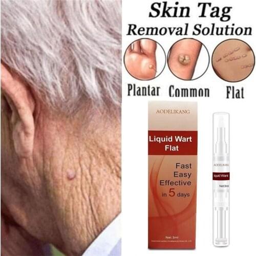 Natural Body Warts Treatment Skin Tag Mole Removal Pen Foot Corn Removal Plantar Genital Liquid Warts Flat Skin Care Repair Pen