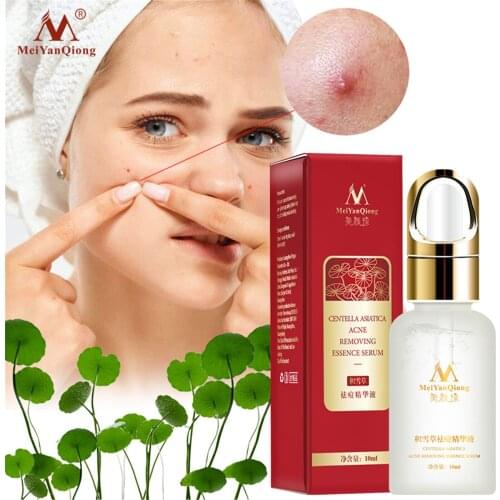 10ml Acne Treatment Face Serum Centella Asiatica Oil Control Serum MeiYan Qiong Treatment Face Serum Centella Asiatica Moisturiz