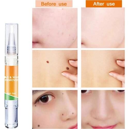 Skin Tag Cure Removal Body Mole Wart Remover Spot Marks Wart Remover Treatment Painless Remover Body Care Skin Care TSLM1