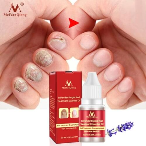 MeiYanQiong Nail Repair Essence Oil Anti-Fungal Nail Infection Hands/Feet Nail Care Promotes 10ml Anti Infection Paronychia