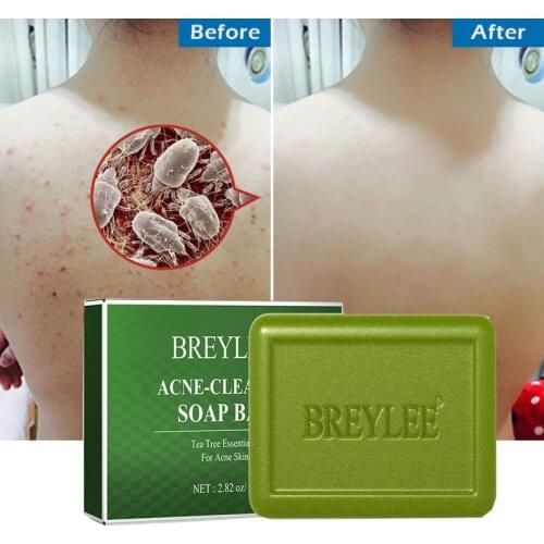 BREYLEE Acne Treatment Tea Tree Soap Bar Oil Control Cleans Moisturize Remove Blackhead Shrink Pore Face Body Dry Skin Care Bath
