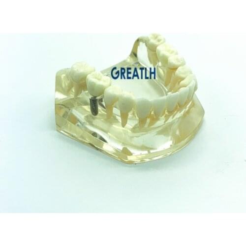 Dental implant fixtures Bridge Model Lower Jaw teeth Implant Typodont dentistry teaching model