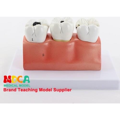 Dental caries decomposition model dentistry oral dentistry display medical teaching model MYC008