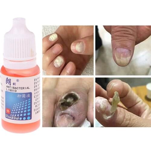 10ml Anti Fungal Nail Infection Chinese Herbal Care Oil Nail Fungus Repair Treatment Pen Products Onychomycosis Paronychia