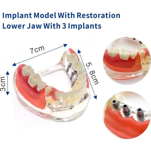Dental Implant Restoration Teeth Model Removable Bridge Denture Demo #6006