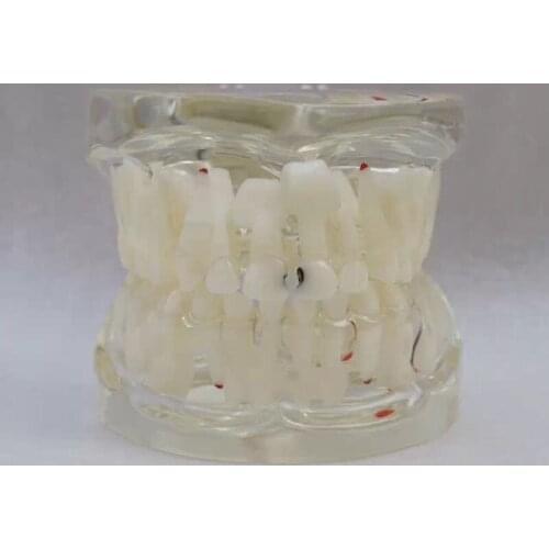 Dental Tooth Milk permanent teeth alternately with Caries teeth model