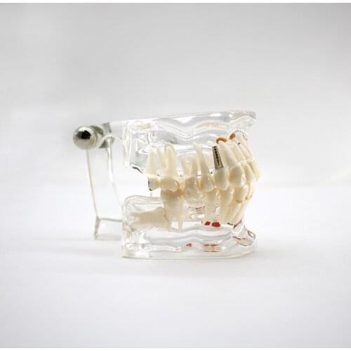 Dental Implant Disease Teeth Model for Medical Teaching Oral Health Care Science Dental Disease Teaching Study