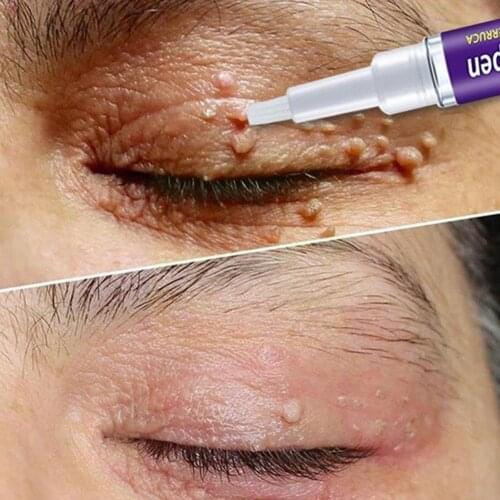 Removal Genital Wart Treatment Papillomas Skin Tags Remover Removing Remedy Moles Effective Anti Against Rapidly Verruca E5Q8