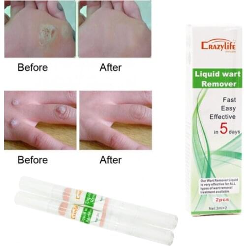 Natural Health Skin Tag Remover 12 hours Tu kill Medical Tu kill Remover Skin Tag Mole & Genital Wart Foot Corn Remover 3ml