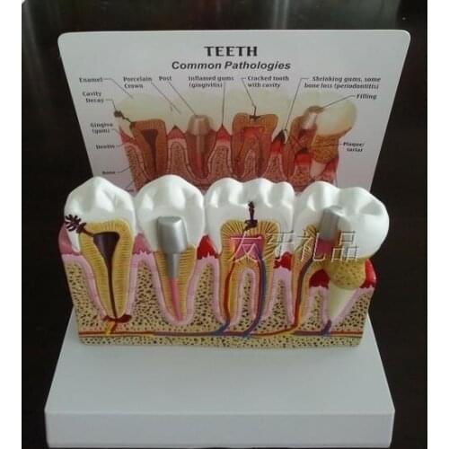 Detachable Tooth anatomy model Dentistry Oral model 16.5*12.8*11CM free shipping