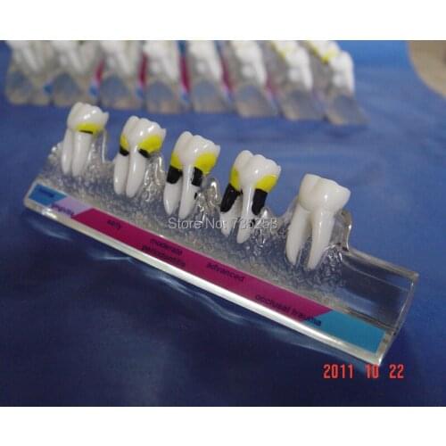 Transparent Periodontal Disease Classification Model,Periodontitis Model