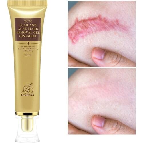 TCM Scar And Mark Removal Gel Ointment Acne Scar Cream Repair Stretch Mark Ointment Gel Anti Acne Treatment Cream TSLM1