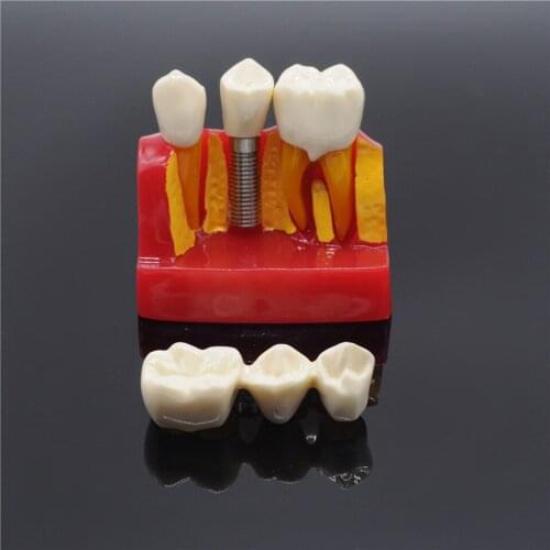 Dentistry Clinic Implant Analysis Crown Bridge Demonstration Teeth Model For Dental Lab