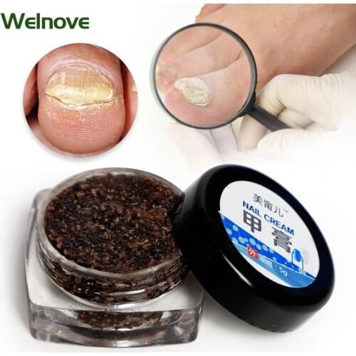 1Pcs Anti-Fungal Cream Nail Treatment Pen Onychomycosis Anti Infection Paronychia Chinese Herbal Care Medical Ointment Foot Care