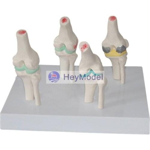 HeyModel Knee Joint pathology Stage Changes Demonstration Model