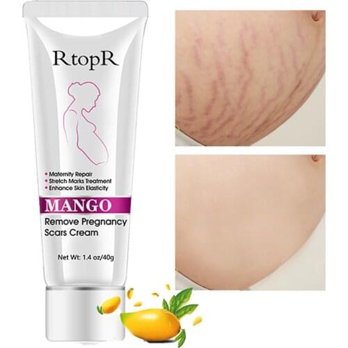 Natural Removal Acne Scar Stretch Marks Cream Fat Scar Striae Gravidarum Treatment Anti-Aging Anti-Wrinkles Firming Body Creams