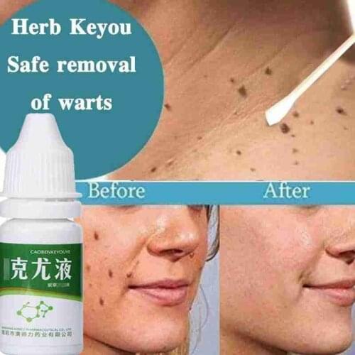 10ml Skin Tags Remove Liquid Treatment Foot Corn Papillomas Mole Plantar Warts Removal Neck Armpit Skin Tag