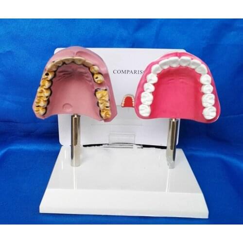 Nursing Tooth Model Medical Pathological Teeth Oral Care Model Tooth Teaching Model Smoking Oral Tooth Model Medical Supplies