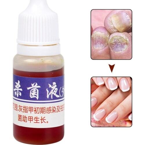 Effective Nail Treatment Liquid Nourish Antifungal Nails Infection Chinese Herbs Liquid Anti-fungus Liquid SK88