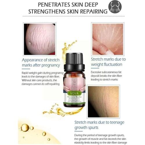 Stretch Marks Remover Pregnancy Repair Essential Oil Lines Improve Nourishing Anti-Aging Fine Skin Anti-Wrinkle Firmness Fa R0X7