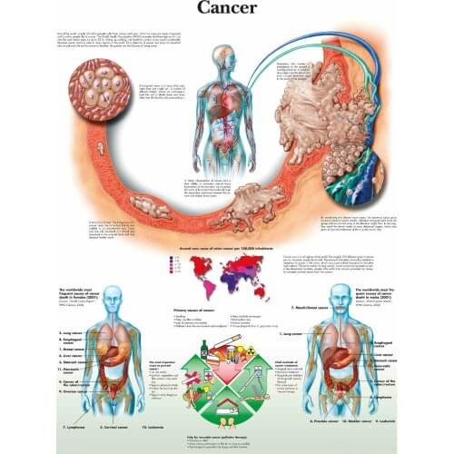 Cancer Chart Picture Art print Silk poster Home Wall Decor
