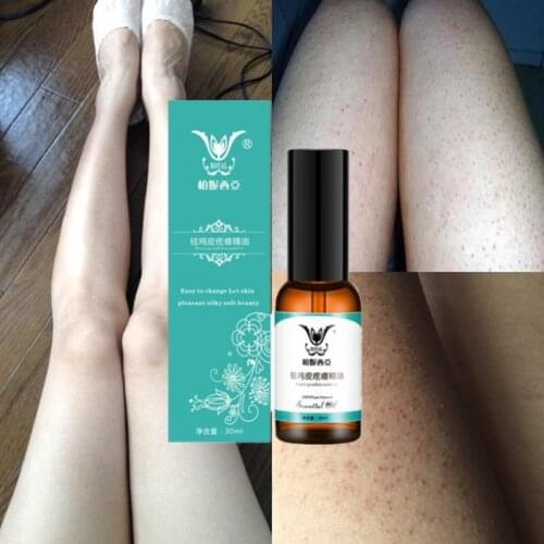 Mint Treatment Body Ichthyosis Leg Keratosis Follicularis Cream Chicken Skin Natural Thigh Fish Scale Body Essential oil