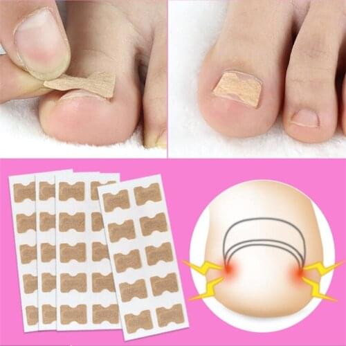 50 stickers Ingrown Toenail Paronychia Treatment Toe nail repair Nail Correction Stickers Pedicure Foot Toe Nail Straightening