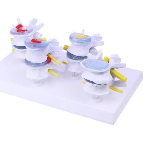 1 Set Human Lumbar Lesion Spine Statue Display Model Medical Teaching Learning Tool