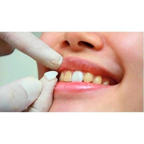 No. 23# L&M&S 3PCS Teeth Veneer Tooth Whitening Dental Ceramic Composite Porcelain Beauty Clinic Anterior Crystal White