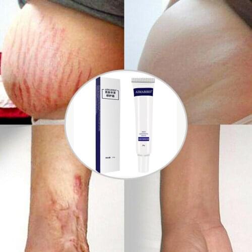 Postpartum Firming And Lifting Cream To Remove Obesity During And Growth Pregnancy Lines Q7V1