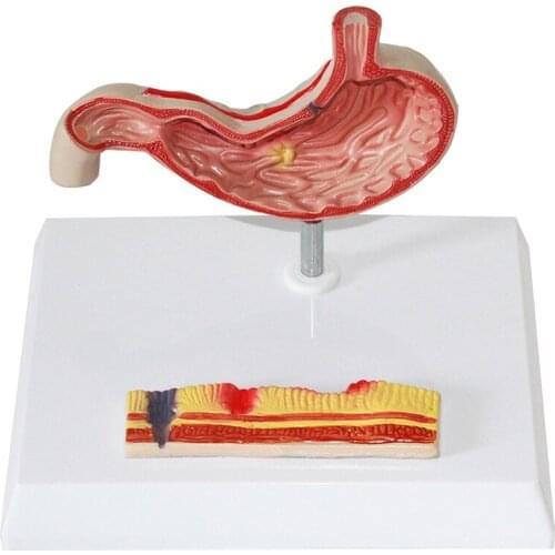Human Stomach Pathology Model Anatomy Stomach Medical Model Anatomic Pathological Teaching Organ Model of Stomach